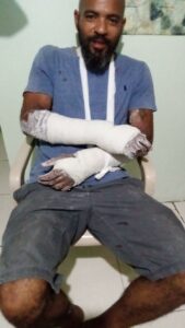 Jodie with casts on arms